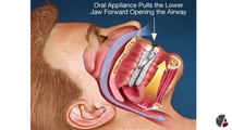 TMJ Appliances, Dentist Dr. Roy Hakala, St. Paul, Minnesota