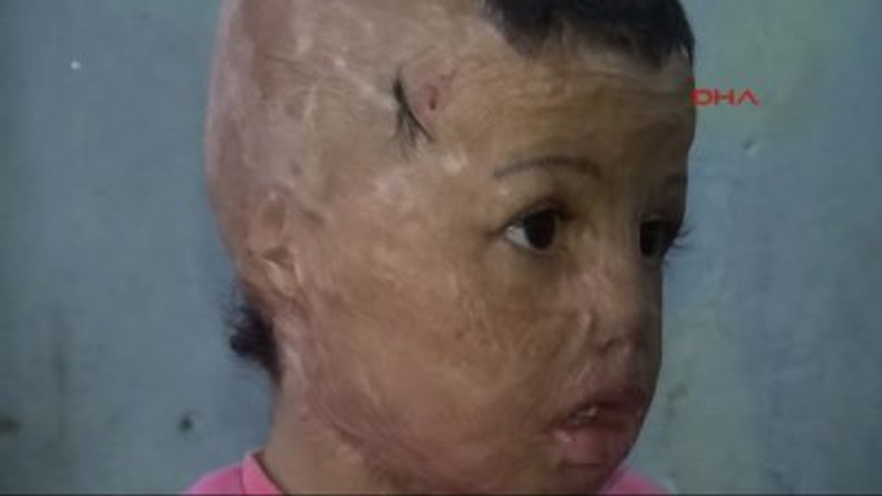 Batman - Kalıcı Makyajla Kaş Yapılan Suriyeli Evin'e Yüz Nakli Yapılacak