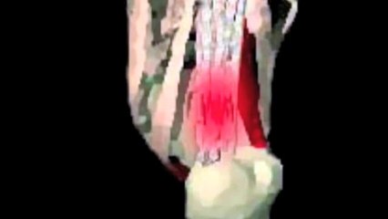 Plantar Fasciitis   Quick