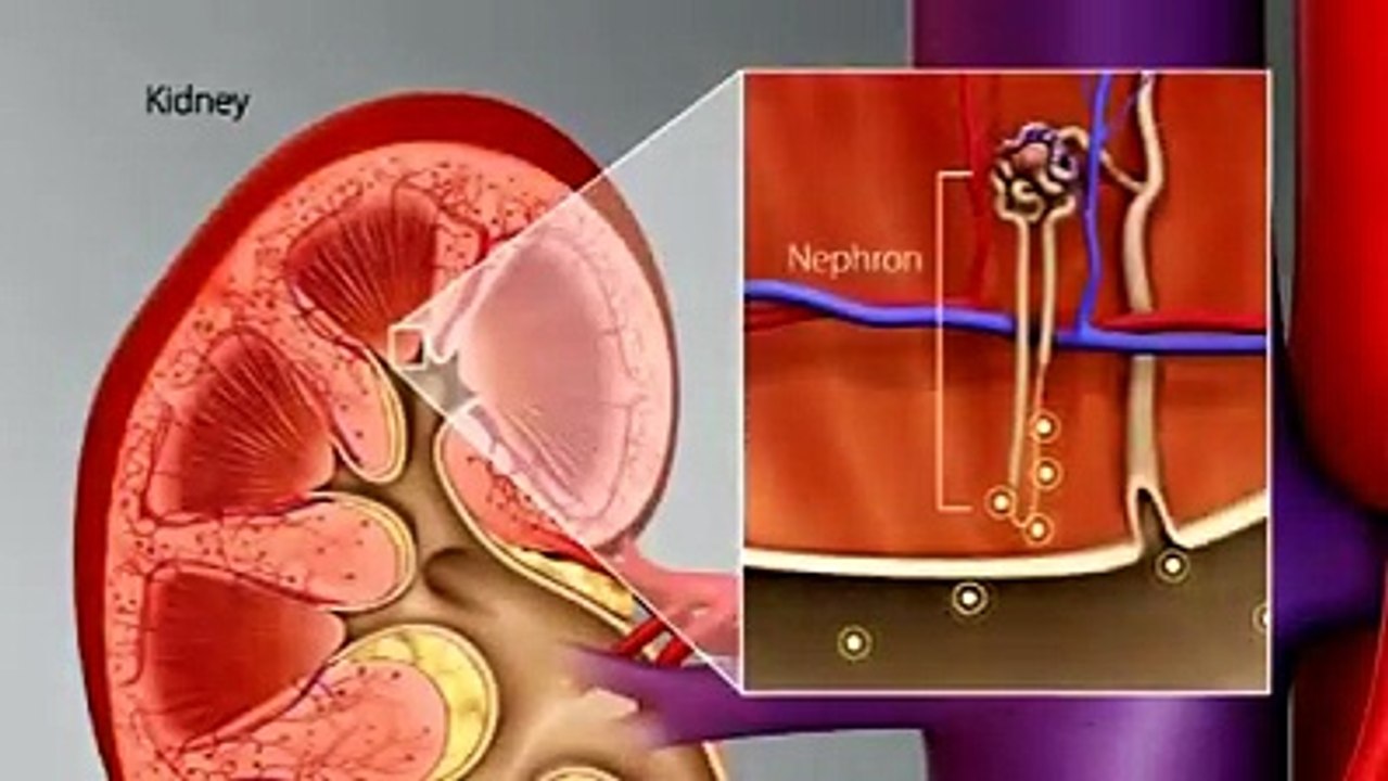 KIDENY STONE DISEASE