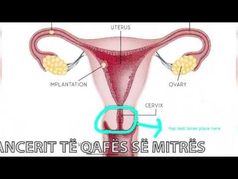 Rreze Dielli, Jo kancer, Java e ndergjegjesimit ndaj kancerit te mitres