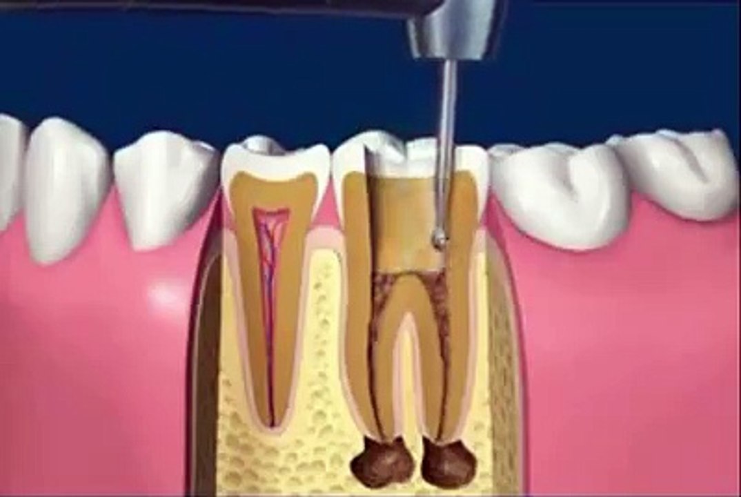 (Kanal tedavisi) nasıl yapılır