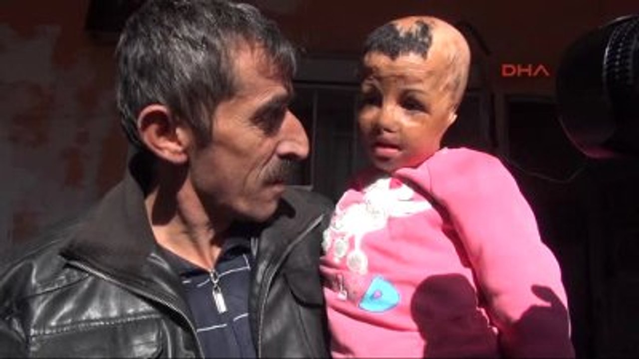 Batman Kalıcı Makyajla Kaş Yapılan Suriyeli Evin'e Yüz Nakli Yapılacak Ek