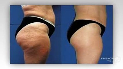 Cellulite Free Review ++AMAZING RESULT++