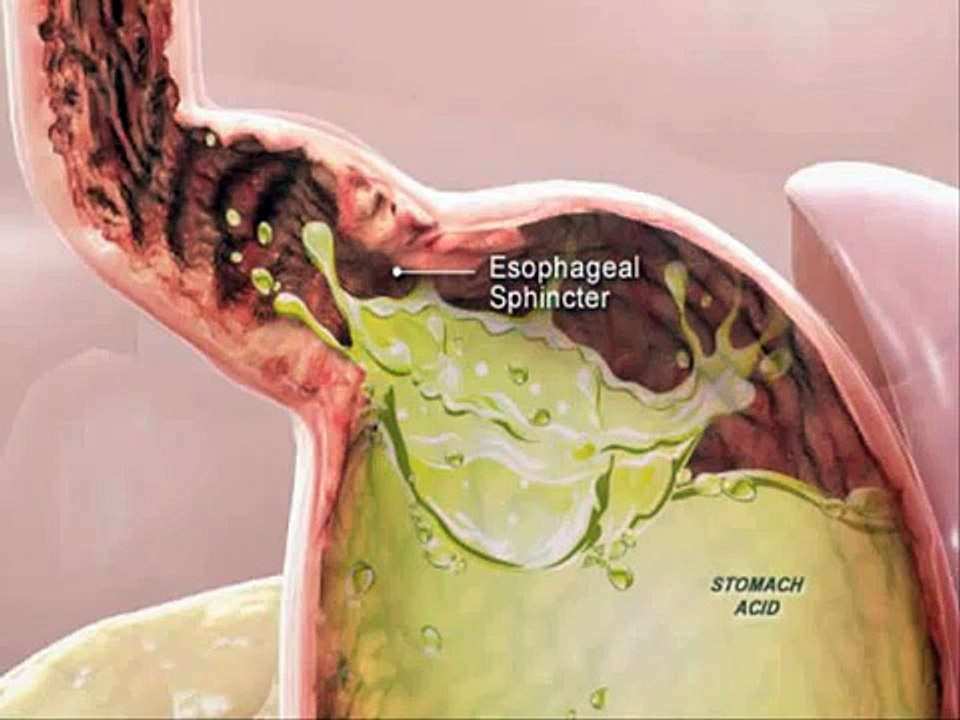 The Heartburn Solution Program