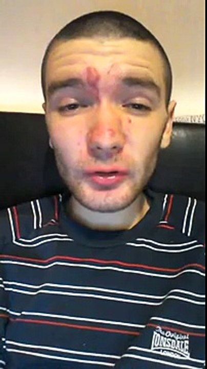 So I have rosacea...