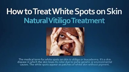 How to Treat White Spots on Skin - Natural Vitiligo Treatment