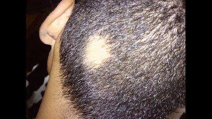 Schluss mit Haarausfall