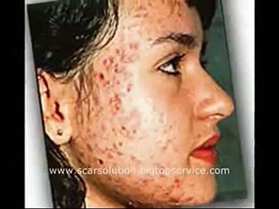 INSTANT SCAR SOLUTION.wmv