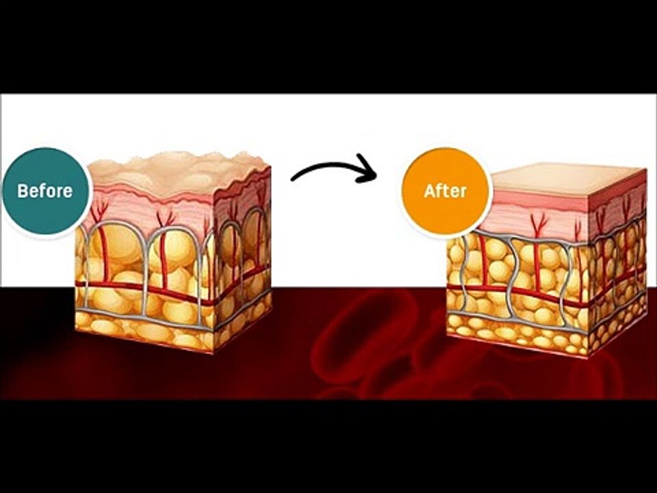 Cellulite Factor Solution Review BY Dr  Charles
