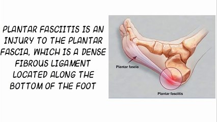 Plantar Fasciitis Treatment for Runners