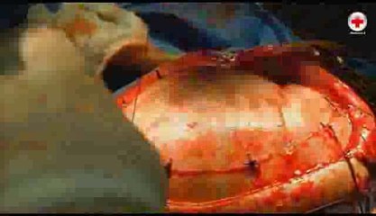 Empiema Subdural - Medicina é