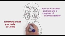 Acne No More ~ Get Rid of Embarrassing Acne, Blemishes and Prevent Scarring Part 2