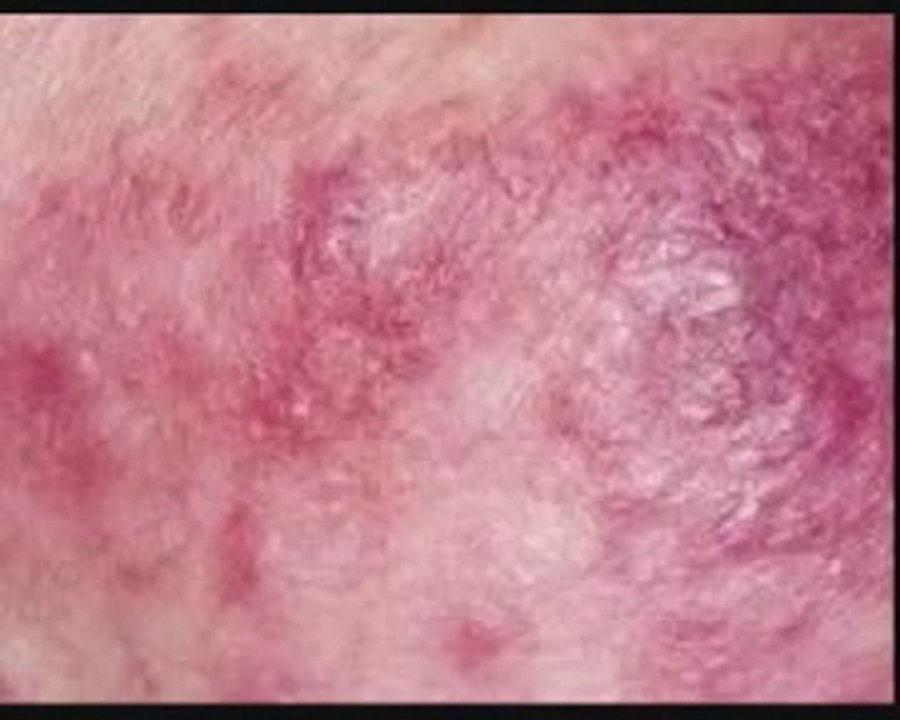 DIY Treatment - Rosacea