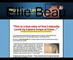 New! - Truth About Lipoma. High Conversions + 75% Commission!