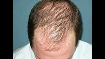 Hair Loss Protocol  Alert scam!