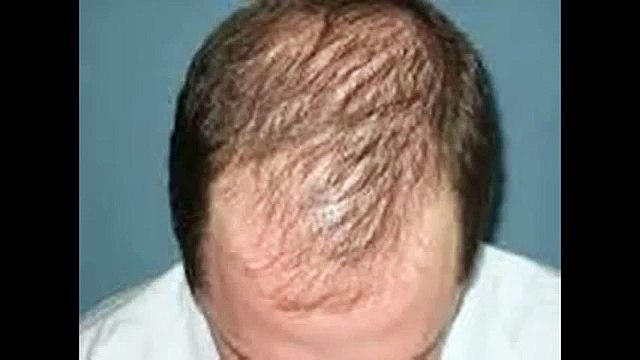 Hair Loss Protocol Alert scam!
