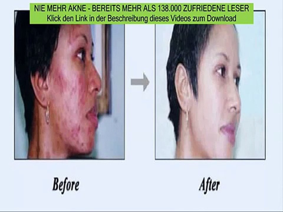 akne was darf ich essen - was hilft gegen akne - nie mehr akne buch download kostenlos