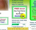 Tonsil Stones Cure - Tonsilloliths