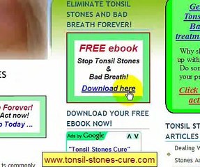 Tonsil Stones Cure - Tonsilloliths