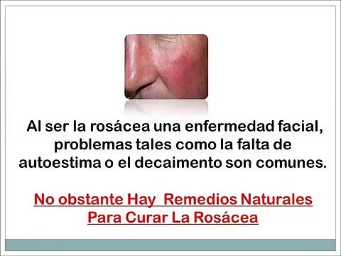 Como Curar La Rosacea Naturalmente - Tratamiento Efectivo Para La Piel
