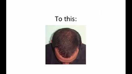 Hair Loss Protocol Review - Does It Really Work