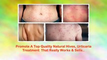 Get Rid Of Hives - Urticaria Hives Treatment - New