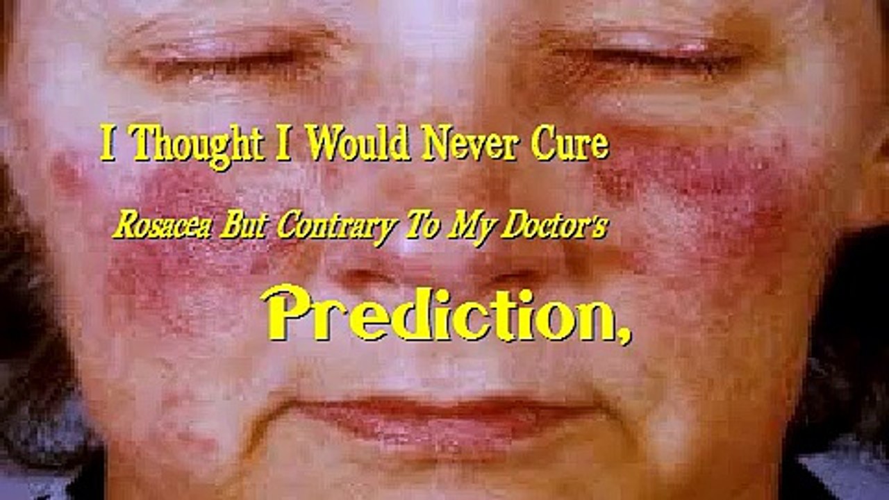 How To Treat Rosacea Naturally