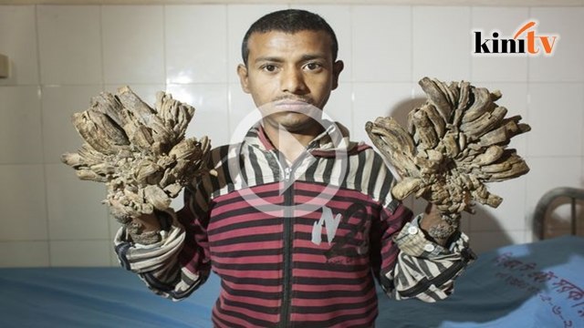 Video: Doktor buntu ubati 'lelaki pokok'