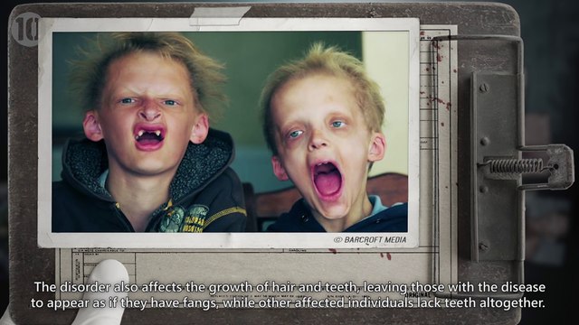 les 10 maladies les plus rares et bizarres du monde