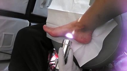 Plantar fasciitis treatment Escondido