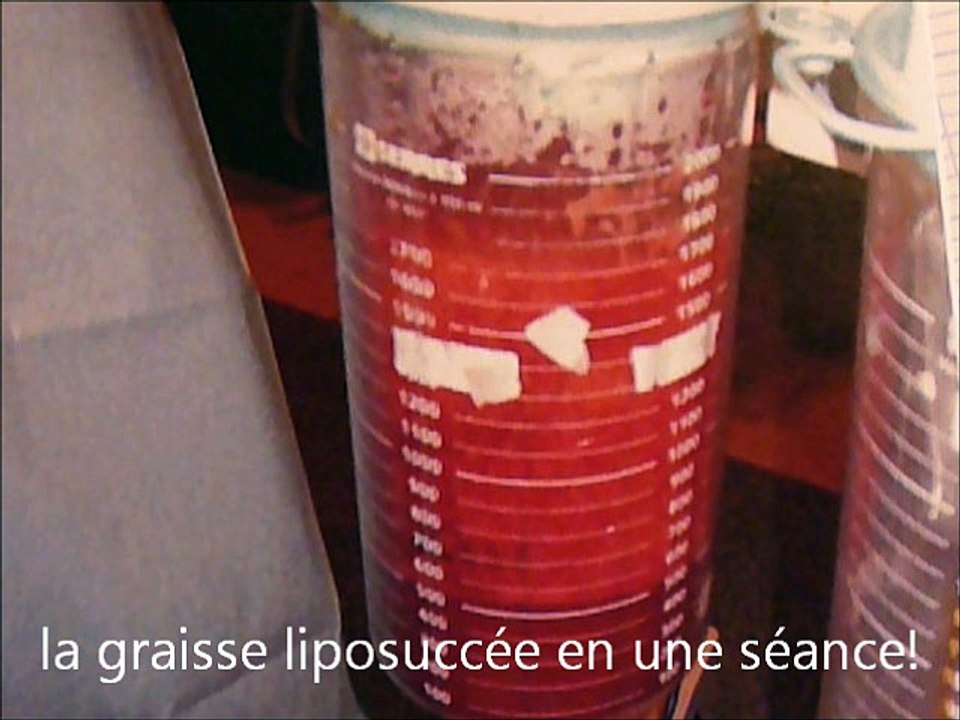 liposuccion ventre,avant après, par vladimir mitz