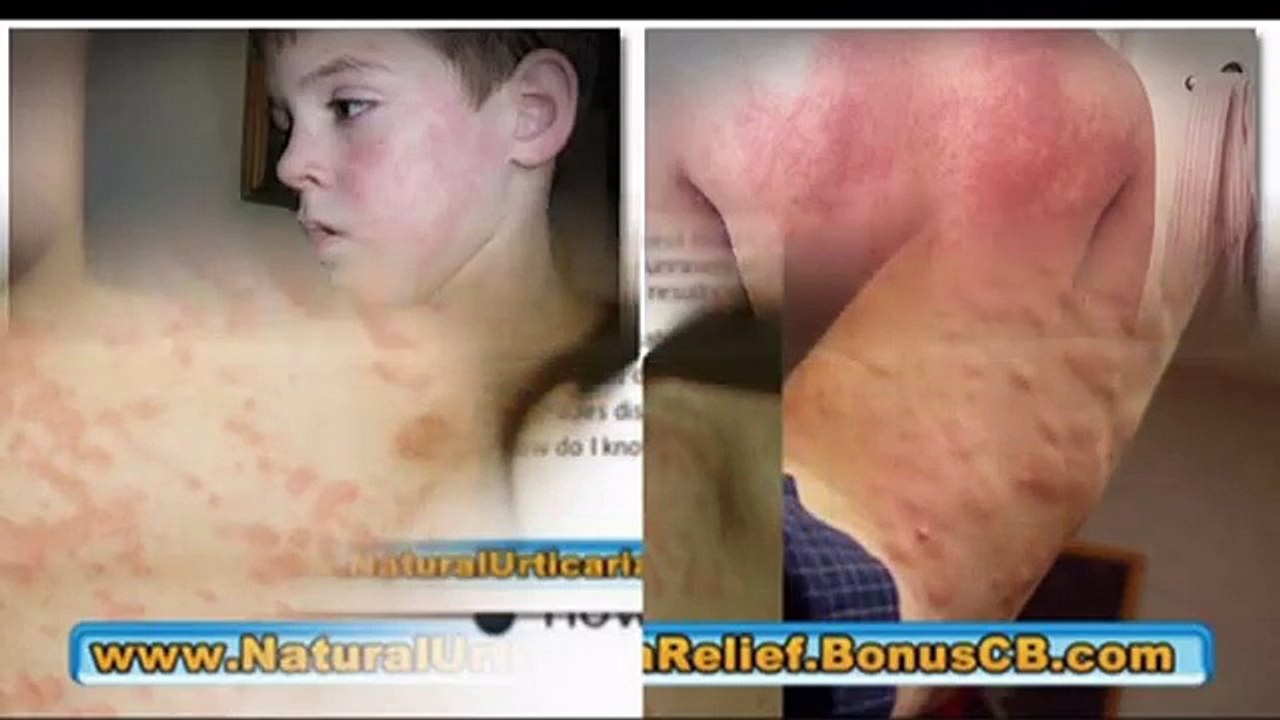 Get Rid Of Hives Urticaria Hives Treatment Reviews-Know What's Good And Bad