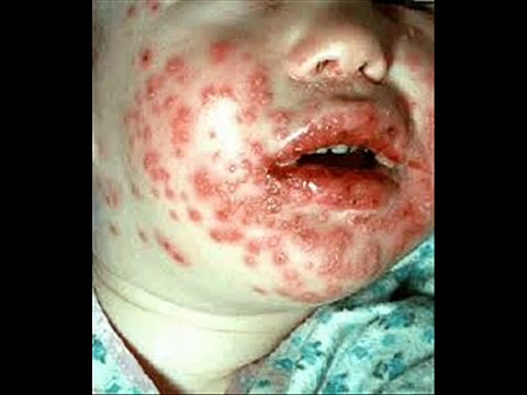 Herpes | How To Get Rid Of Herpes virus Fast