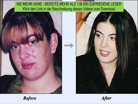 akne im erwachsenenalter - akne auf dem rücken bekämpfen - nie mehr akne system erfahrungen