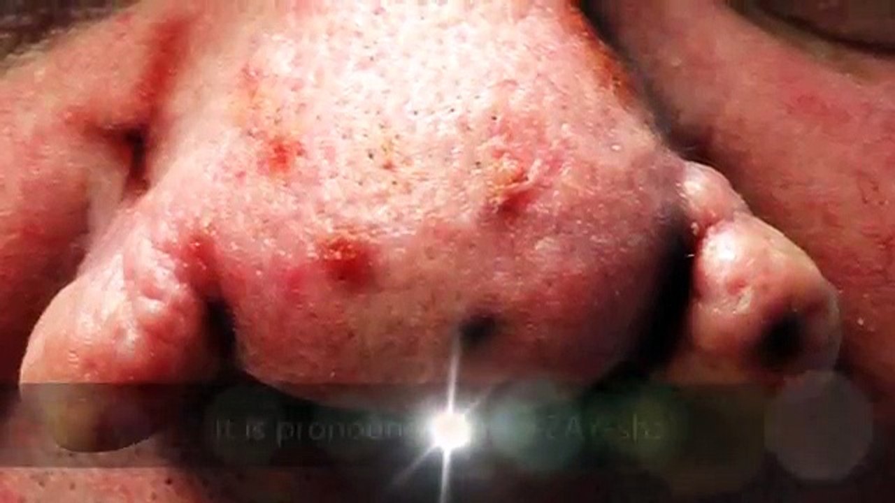 Rosacea Answers - What is  Rosacea?