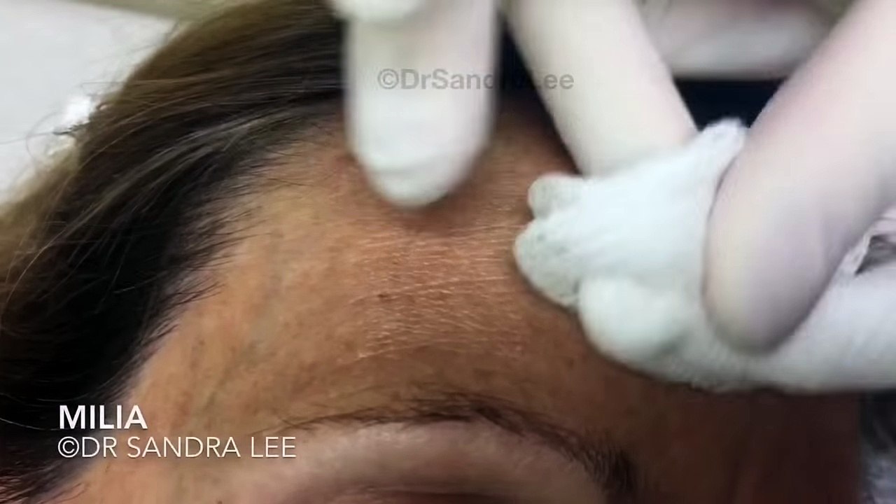 A husband & wife  Popping milia, blackheads, and more. For medical education- NSFE.