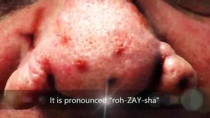 Rosacea Answers   What is Rosacea