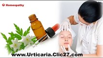 Natural Urticaria Relief | Natural Relief For Hives