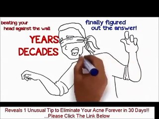 ✔✔Where To Buy Acne No More Book - Best Acne Treatment✔✔