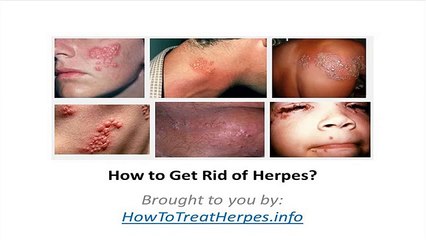 How to Get Rid of Herpes | HowtoTreatHerpes.info