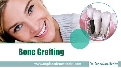 Dental Implant Procedure in Bangalore |  Best Dentist in India