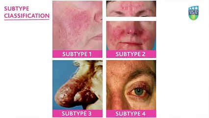 Current concepts on rosacea