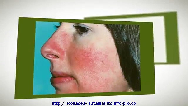 ☀☀☀Aloe Vera Rosacea, Remedios Caseros Para Quitar La Rosacea, Rosacea Tratamiento Casero*