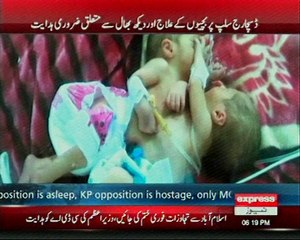 conjoined twins report