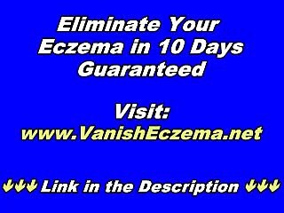 Beat Eczema: Don&#39;t Just Control It