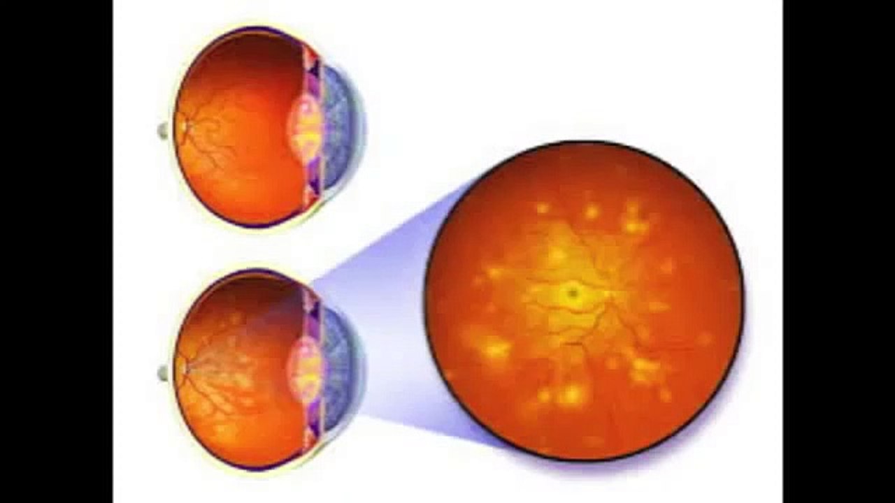 Watch Eye Floaters No More Review // Review Of Eye Floaters No More Review