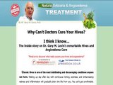 Find a Full Urticaria Cure By Dr Gary M.d | Converts 1:34 Review