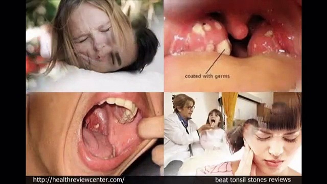 Beat Tonsil Stones Reviews-Is it Scam or Does it Work?