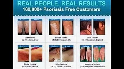 The Psoriasis Revolution Review – Does It Really Work?